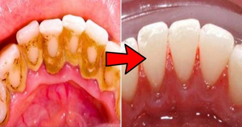 Naturally Whiten Teeth: 10 Ways To Remove Tartar Stains From Your Teeth