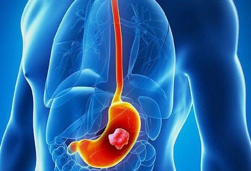 9 triệu chứng UT dạ dày giai đoạn đầu giúp phát hiện sớm bệnh