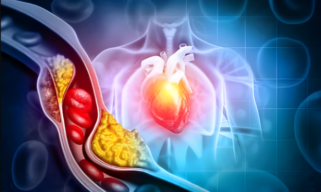 Cholesterol cao: Ăn gì để giảm mỡ máu?