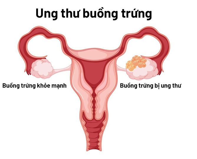 9 dấu hiệu của UT buồng trứng cần biết sớm để điều trị