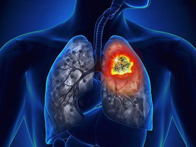 9 dấu hiệu UT phổi giai đoạn đầu bạn không nên bỏ qua