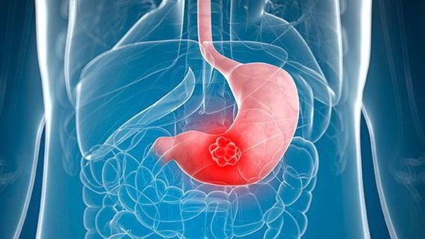 Nếu có 3/7 dấu hiệu này thì đi khám ngay, đừng để UT dạ dày đến khi đã quá muộn