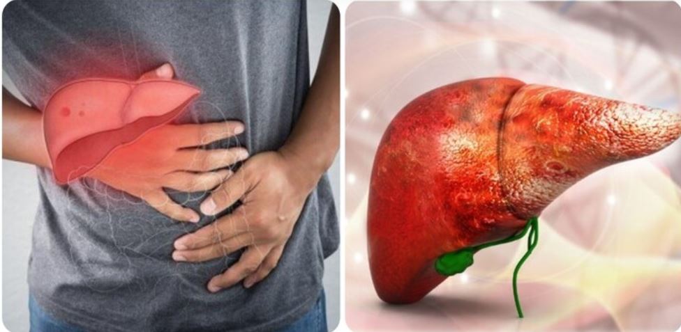 Dấu hiệu UT gan bạn không nên bỏ qua