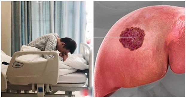 Bệnh nhân qua đời sau 60 ngày phát hiện UT gan, BS khẩn cầu: Đừng ăn 2 món h:ủy d:iệt gan nữa