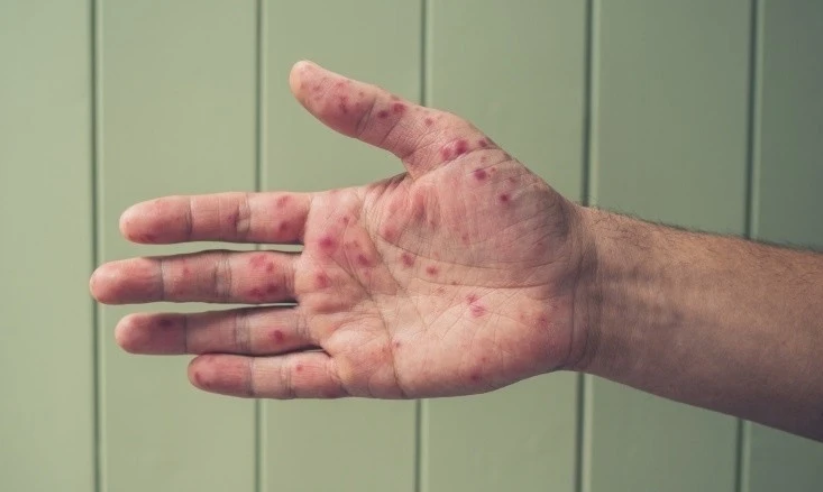 Loại virus đang lan ‘vượt ngoài tầm kiểm soát’